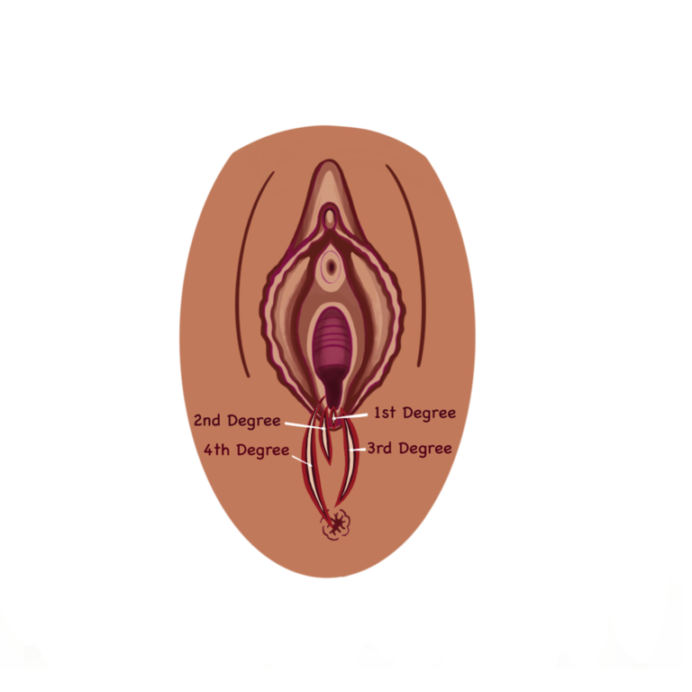 Illustration of where a 1st, 2nd, 3rd and 4th degree tear appear on the perineum.